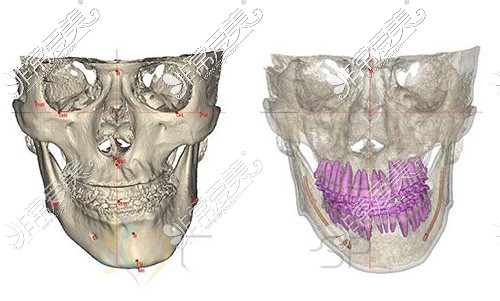 颌面轮廓CT照片