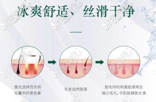 韩氏冰点脱毛的优势