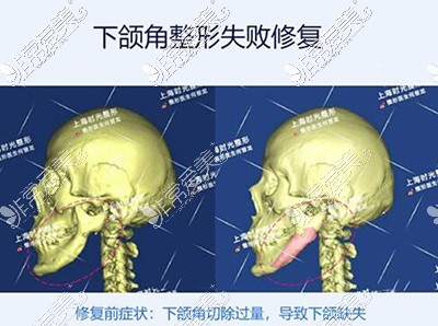 何晋龙下颌角失败整形照片