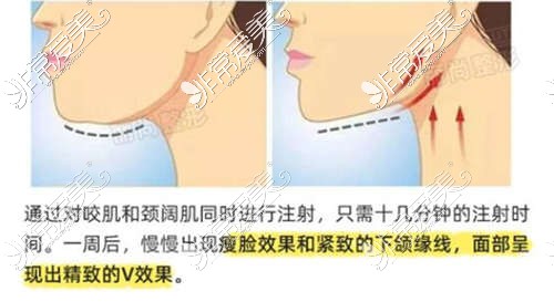 广州瘦脸针在哪里打比较好?分享广州注射瘦脸针好的医院