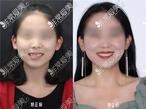 2021重庆箍牙齿哪家医院好?暑假矫正这5家箍牙价格便宜实惠!