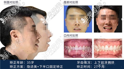 重庆牙博士口腔正畸对比