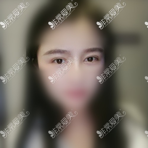 上海华美眼修复术后35天