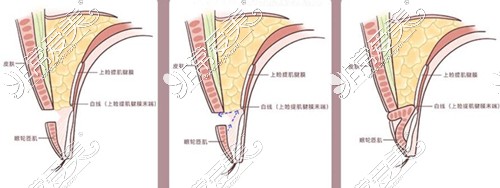 kiss法雙眼皮手術(shù)原理