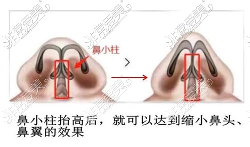 常州做鼻翼肥大整形医院有哪些，鼻翼缩小费用价格是多少