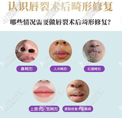 成人兔唇整形需要多少钱，大人做兔唇可以整好吗？