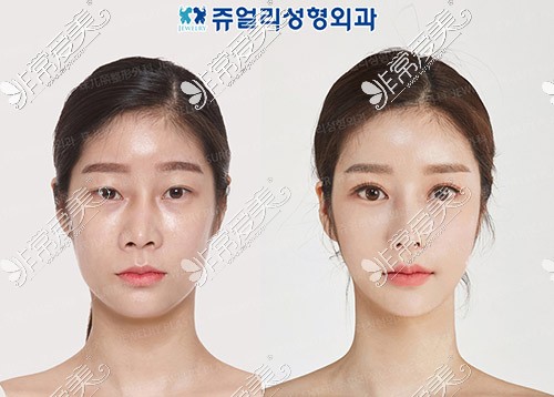 韩国全脸整形手术前后对比图