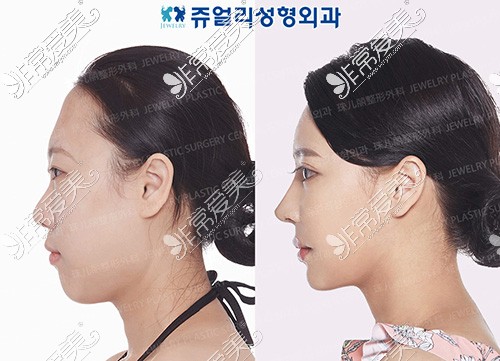 韩国珠儿丽整形面部综合改善对比