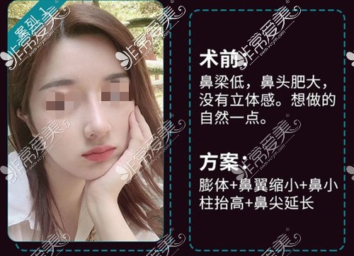 佛山华美鼻子谁做得好?雷朝勇院长真实鼻部手术效果展示!