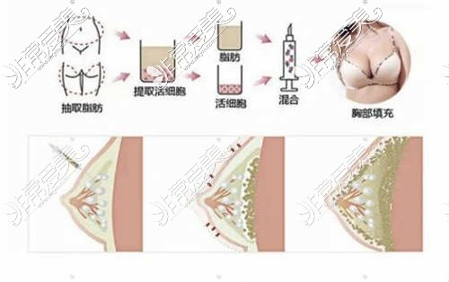 濟(jì)南藝星整形醫(yī)院脂肪提取填充等過程