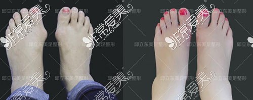 北京圣嘉新医疗美容邱立东医生大脚骨手术对比照片