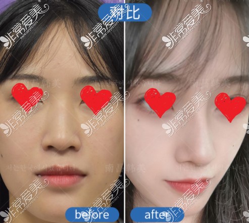 南昌韩美方长亮做鼻子怎么样?方长亮鼻整形效果及特色解析!