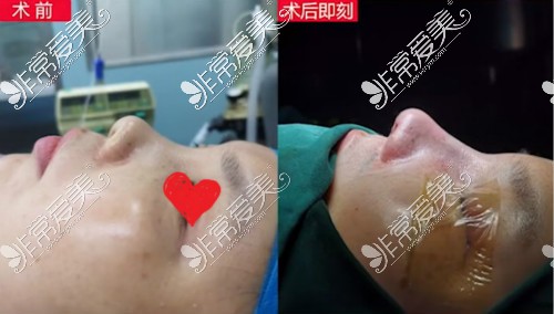 南昌韩美方长亮做鼻子怎么样?方长亮鼻整形效果及特色解析!