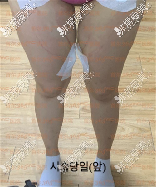 韩国365mc医院大腿吸脂当天