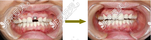 门牙种植对比图