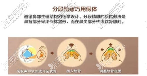 分段隆鼻方式更自然