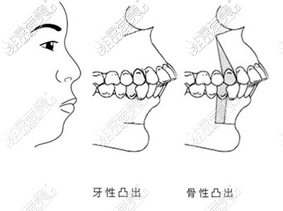 骨性凸嘴正颌手术费用公布,详细价格表揭秘正颌要多少钱!