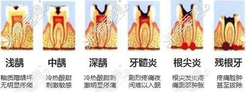 说牙髓炎不用治尽量不做根管治疗 这些人不是庸医就是骗子