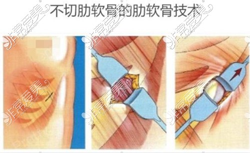 上海时光整形宋茂启肋软骨取肋技术