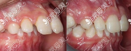 龅牙矫正前后对比