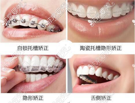 牙齿矫正牙套