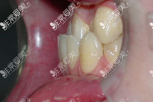 地包天的牙齒形態(tài)