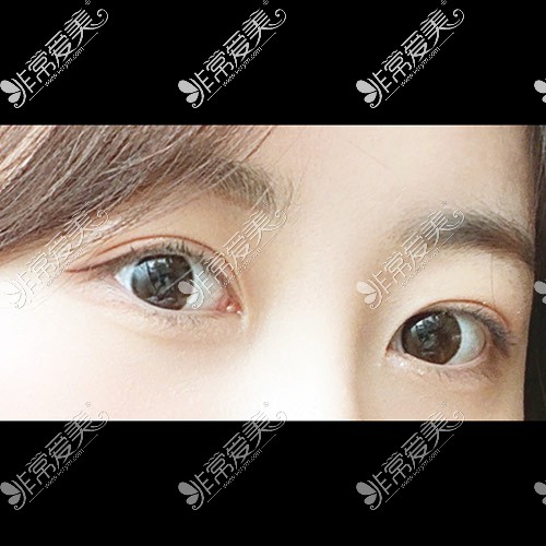 韩国ICON整形医院双眼皮图片