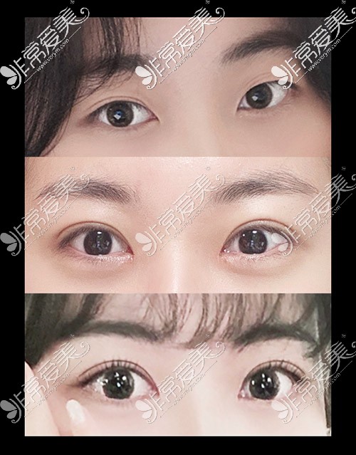 韩国ICON整形医院双眼皮恢复图