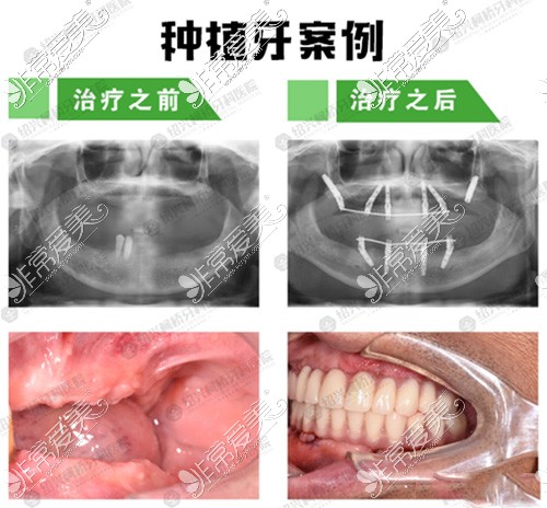 绍兴柯桥牙科医院种植牙<span style=