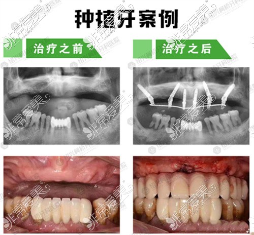 绍兴柯桥牙科医院种植牙<span style=