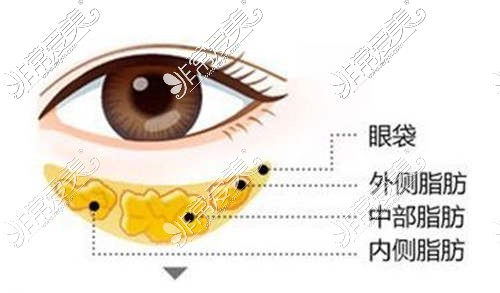 眼袋脂肪分布