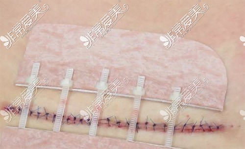 手术祛疤伤口图片