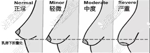 乳房下垂矯正程度分級(jí)