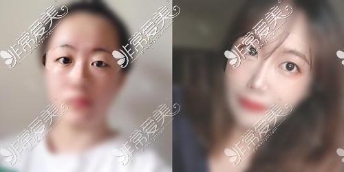 贵阳利美康整形刘德东双眼皮<span style=