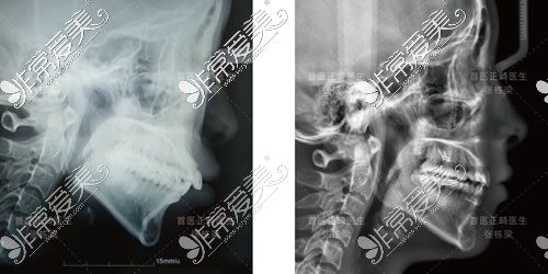 北京禾禾齿科牙齿矫正前后CT图片对比