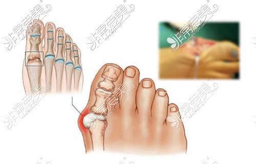 大脚骨手术过程图