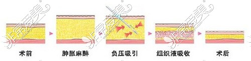 貴陽艾洛琳必嫵整形吸脂示意圖