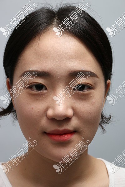 韩国德丽珍全脸整形照片