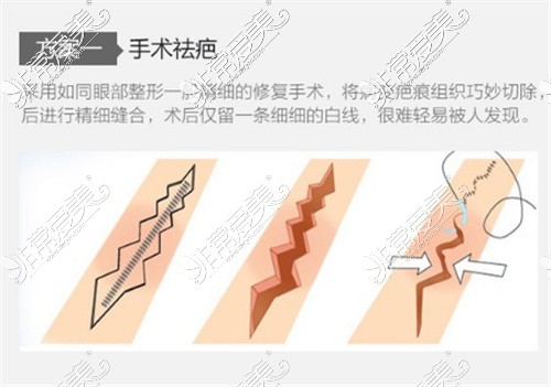 10厘米祛疤手术多少钱？祛疤痕手术多少钱一厘米？