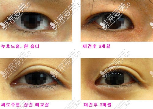 韩国EVE整形外科内眼角修复