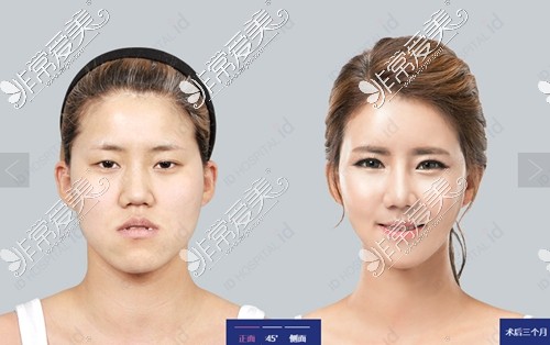 韩国ID整形医院下颌发育过度矫正效果