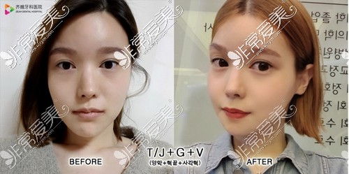 韩国齐娥牙科双鄂手术前后对比照片