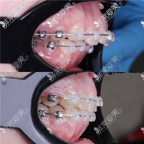 贵阳牙齿矫正前后对比