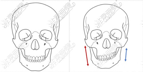 牙性和骨性偏颌示意图图片