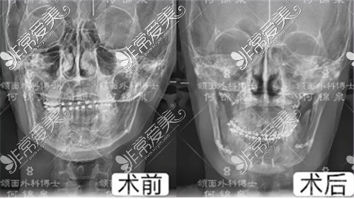 骨性偏颌手术CT对比图