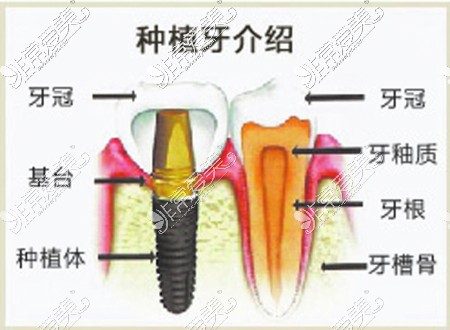 种植牙介绍