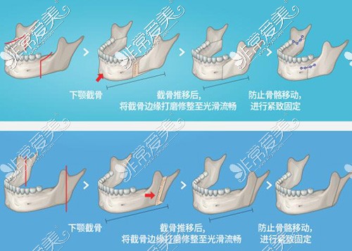 下颌骨整形手术示意