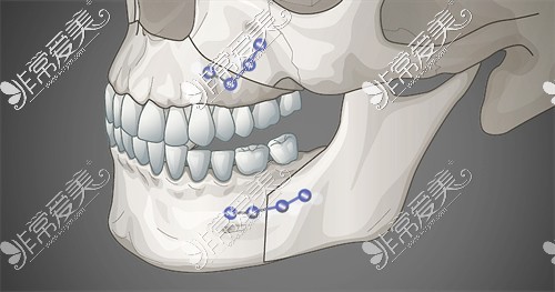 骨性偏颌做正颌手术原理展示