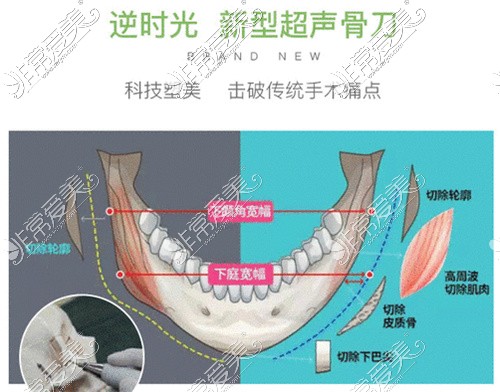 杭州做下颌角哪里好?杭州下颌骨磨骨这几家技术有保障!