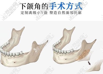 郑州磨骨瘦脸手术价格表公布,包括下颌角颧骨各部位费用!